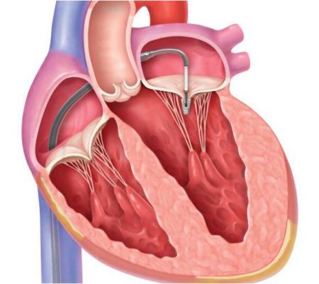 Mitral Kapak Yetmezliği ve Kalp Sağlığı Üzerine Etkileri