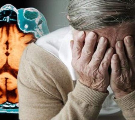 Alzheimer Araştırmalarında Şaşırtıcı Gelişme