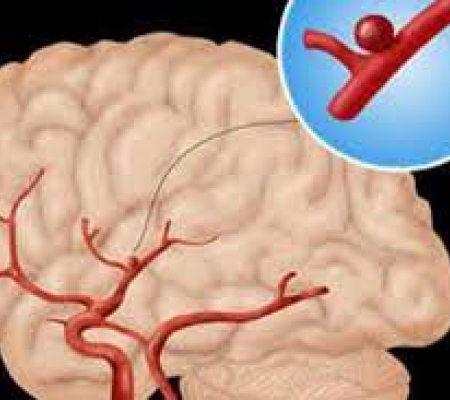 Anevrizmada Genetik Yatkınlığa Dikkat