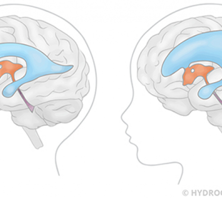 Hidrosefali: Patofizyoloji, Klinik Belirtiler ve Modern Tedavi Yaklaşımları